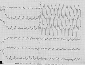 Electrocardiograma en dosis máximas; aparición de bloqueo de rama izquierda.