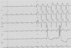 Electrocardiograma en la recuperación tardía; persistencia del bloqueo de rama izquierda.