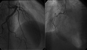 Angiografía coronaria; coronarias epicárdicas sanas.