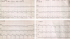 Electrocardiograma de ingreso. Elevación del segmento ST de 0,2mV en aVL y de 0,1mV en DI con descenso de este en las derivadas de la pared inferior.