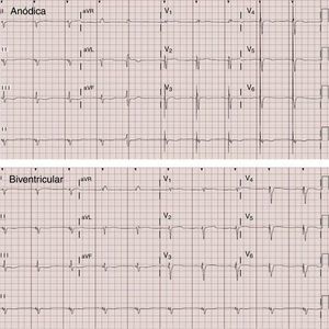 Comparación electrocardiográfica con estimulación anódica (QRS 110ms) frente a biventricular (QRS 129ms). Nótese el estrechamiento del complejo QRS.