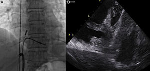 A. Imagen de tracción con catéter SNARE, se muestra posición de sonda de ecografia intracardíaca. B. Imagen de ecografia intracardíaca con presencia de deformación del ventrículo derecho, creación de cavidad virtual con presencia de hipotensión e inestabilidad hemodinámica con la tracción.