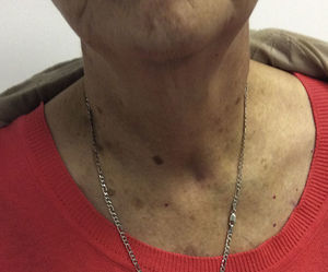 Imagen de paciente posterior a 1 mes de procedimiento de extracción exitoso.