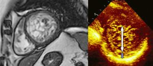 Imágenes por RM cardiaca y ecocardiografía en eje corto del segmento medio ventricular izquierdo que demuestra la presencia del VINC.