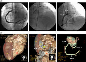 Anatomía coronaria. (a) coronariografía con inyección selectiva de arteria coronaria derecha (ACD) que llena simultáneamente el árbol coronario izquierdo, (b) angiotomografía con reconstrucción volumétrica «redenderizada». Las imágenes muestran una arteria coronaria única (ACU) originada en seno coronario derecho, arteria coronaria derecha (ACD) hiperdominante, descendente anterior (ADA) y circunfleja (ACX) de pequeño tamaño originadas proximalmente de la ACD. AI, aurícula izquierda; VI, ventrículo izquierdo; VD, ventrículo derecho; AO, aorta; AP, arteria pulmonar; DP, descendente posterior.