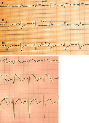 EKG (muestra elevación del segmento ST en las derivaciones V1-V3 con el patrón típico de SB tipo I).