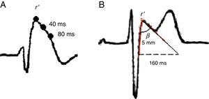 Patrones electrocardiográficos de SB. Tomado de Current electrocardiographic criteria for diagnosis of Brugada pattern: a consensus report.