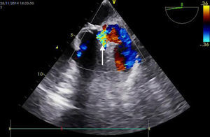 Ecocardiograma transesofágico, proyección esófago medio, evidencia disrupción a nivel de unión auriculoventricular.