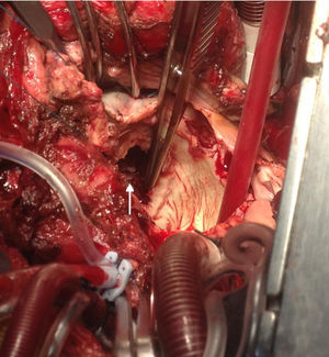 Imagen intraoperatoria en donde se identifica el sitio de la disrupción auriculoventricular posterior al retirar la prótesis.
