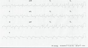 Electrocardiograma de 12 derivaciones. Taquicardia ventricular polimórfica bidireccional.