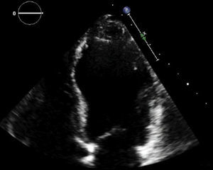 Ecocardiograma transtorácico. Aproximación ventricular. Severa dilatación ventricular izquierda, áreas de adelgazamiento e hiperrefringencia miocárdica. FEVI 33%.