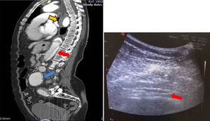 Caso 2. Dolor torácico, hipertensión y diaforesis. Manejada como angina. Valorada con protocolo RUSH, imágenes de la aorta abdominal. Flechas rojas: Flap de la disección abdominal. Flecha naranja: Hematoma intramural. Flecha azul: Aneurisma de la aorta infrarrenal.