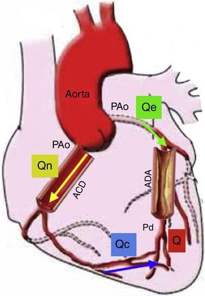 Modelo de la circulación coronaria: donde Qe indica el flujo hiperémico con estenosis, Qn es el flujo hiperémico sin estenosis, y Qc es el flujo colateral. Q va a ser la suma del flujo anterógrado a través de la estenosis (Qe) y el flujo colateral (Qc). Entonces el FFR es igual a Q/Qn es decir Pd/PAo. En esta gráfica se representa el flujo sanguíneo colateral (Qc), el cual afecta el resultado del FFR; sin embargo, también podría medirse la suplencia colateral por FFR como ya se explicó en el texto. Si no existiera estenosis de la arteria descendente anterior (ADA), Q sería igual a 0, Qe sería igual a Qn, así como Pd sería igual a PAo. Presión aórtica (PAo), Presión distal (Pd), Arteria coronaria derecha (ACD) (Modificado de Circulation. 2006;113:446-455)22.