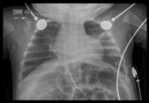 Radiografía de tórax luego de lograr la extubación.