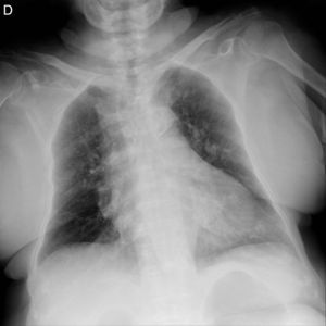 Chest X-ray, showing a large, ovoid, dense structure overlying the cardiac silhouette.