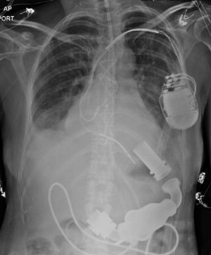 Radiografía de la paciente que muestra los componentes de HeartMate II y el cardiodesfibrilador previamente implantado.
