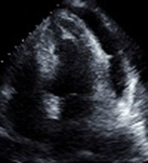 Función sistodiastólica biventricular conservada, dilatación leve de auricular, derrame pericárdico 700 cc.