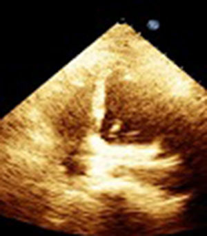Control ecocardiográfico mejoría de ventrículo derecho, manteniendo buena función sistólica izquierda.