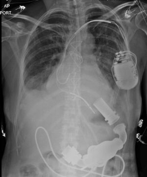 Radiografía de la primera paciente con HeartMate II que muestra los componentes del dispositivo.