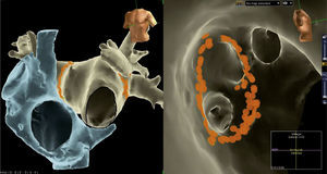 A la izquierda, se observa una reconstrucción 3D mediante la fusión de una imagen tomográfica con el sistema NavX. En azul la aurícula derecha y en ocre la aurícula izquierda. Se aprecian los dos orificios de las válvulas tricúspide y mitral y los puntos amarillos representan los sitios de aplicación de radiofrecuencia en los antros pulmonares. A la derecha, una vista endocavitaria de la aurícula izquierda durante aislamiento de venas pulmonares. En los puntos amarillos se ha practicado ablación alrededor de las venas pulmonares izquierdas.