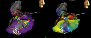 Mapa de activación (izquierda) y de voltaje (derecha) del ventrículo izquierdo. La zona gris representa la cicatriz eléctrica.
