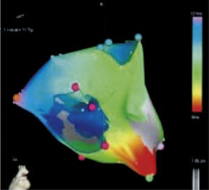 Imagen de una taquicardia de origen focal en la aurícula derecha (zona más precoz en color rojo). Tomado con permiso de Vanegas1.