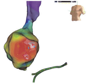 Taquicardia auricular focal con ablación exitosa en la región posteroseptal.
