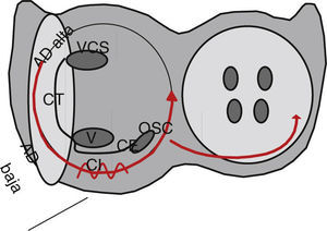 Esquema del circuito de flutter auricular típico. Se observan los anillos tricuspídeo y mitral en proyección oblicua izquierda anterior 40°. El circuito antihorario circula anterior a la crista terminalis (CT), entre los orificios de la vena cava superior (VCS) y la vena cava inferior (VCI), continuando por el istmo cavotricuspídeo (IC) a través de la cresta de Eustaquio, que es la zona de conducción lenta, ascendiendo por la pared septal después del ostium del seno coronario (OSC). El flutter auricular típico reverso tiene los mismos accidentes anatómicos pero en sentido horario. En esta proyección el istmo cavotricuspídeo se puede dividir en septal (hacia el OSC), medio y lateral.
