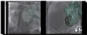 Reconstrucción tridimensional en la que se utiliza angiografía rotacional y fluoroscopia. Se fusiona la angioTAC con la imagen fluoroscópica a través de un software (EP navigator® de Philips). Permite la visualización en tiempo real de los catéteres dentro de la cámara estudiada, en este caso la aurícula izquierda.