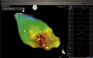 Reconstrucción electroanatómica del ventrículo izquierdo (CARTO) con localización del fascículo posterior (círculos amarillos), con lesiones de radiofrecuencia (círculos rojos) que cruzan el fascículo en forma perpendicular. Como en otras patologías arrítmicas, existen pacientes en quienes no se desea la exposición a los rayos X. Un estudio reciente con 19 pacientes que presentaban taquicardia ventricular idiopática utilizó ecocardiograma intracardiaco y mapeo tridimensional sin fluoroscopia. Los autores lograron 100% de éxito en la ablación; 11% de los pacientes tenían taquicardia ventricular fascicular13.