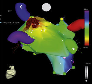 Reconstrucción tridimensional de la aurícula izquierda, mediante sistema CARTO, en un paciente de 6 años con taquicardia auricular focal.