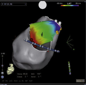 Reconstrucción tridimensional del ventrículo izquierdo y el anillo mitral mediante el sistema CARTO 3, con toma de puntos de activación, en un paciente con presencia de una vía accesoria posterior izquierda.