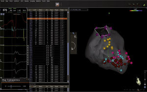 Mapa tridimensional del ventrículo izquierdo con sistema CARTO 3, has de His (puntos amarillos), fascículo posteroinferior (puntos azules) y potenciales diastólicos (puntos rosados) en un paciente con taquicardia ventricular fascicular posteroinferior, en quien se realizó transección del fascículo.