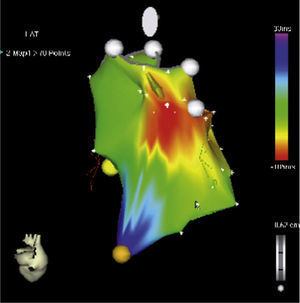 Reconstrucción tridimensional del tracto de salida del ventrículo derecho mediante sistema CARTO 3 en un paciente con taquicardia ventricular idiopática de este origen.
