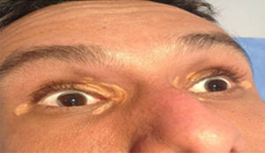 Imagen de arco corneal y xantelasmas en un paciente menor de 45 años.