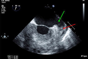 Trombo en el apéndice auricular izquierdo (flecha roja) y contraste denso espontáneo (flecha verde) identificados por ecocardiograma transesofágico.