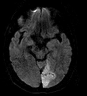 IRM de paciente con infarto agudo de la arteria cerebral posterior izquierda secundario a fibrilación auricular con hiperintensidad en DWI.