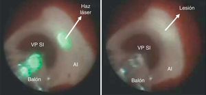 Balón en la vena pulmonar superior izquierda (VPSI), aplicando energía láser y aspecto de las lesiones causadas.
