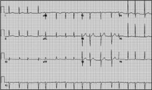 Electrocardiograma de un paciente en ritmo de fibrilación auricular. Se aprecia la ausencia de ondas p y la presencia de un RR variable.