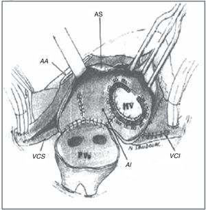 Cirugía de maze III. Representación esquemática de la cirugía de laberinto (Maze). Se aprecia la canulación bicava, las incisiones en vena cava superior e inferior (VCS, VCI), la sección del apéndice atrial derecho (AA), la incisión del septum interauricular (As), la aurícula izquierda (AI) y la válvula mitral, sobre la que se ha colocado un anillo (MV). Adaptada de: Sandoval N., Tratamiento quirúrgico de la fibrilación auricular. En: Franco, S. (Ed). Enfermedad Valvular Cardiaca, 1.a ed. 2004. p. 289.