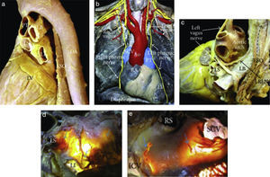 (a) Vista en perspectiva posterolateral izquierda que muestra el curso del esófago y descendente de la aorta respecto a la aurícula izquierda. (b) En disección de un cadáver se ve desde la parte frontal, muestra el curso de los nervios frénicos derechos e izquierdos y los nervios vagos. (c) Disección del nervio vago izquierdo y su rama del laríngeo recurrente izquierdo, que desciende sobre el techo de la aurícula izquierda. (d, e). Transiluminación del techo de la aurícula izquierda y el surco interauricular posterior en donde se aprecian los plexos ganglionares epicárdicos de la acetilcolinesterasa de colores (flechas azules) que se extienden a la superficie de la unión venoauricular izquierda en (d) y región intercaval en (e)5. Ao=aorta, LB=bronquio izquierdo, DA=aorta descendente, ESO=esófago, ICV=vena cava inferior, LI=vena pulmonar inferior izquierda, LRLN=nervio laríngeo recurrente izquierdo, LS=vena pulmonar superior izquierda, LV=ventrículo izquierdo, PT=tronco pulmonar, RAA=apéndice auricular derecho, RI=vena pulmonar inferior derecha, RS=vena pulmonar superior derecha, y SCV=vena cava superior.