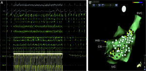 A. Respuesta parasimpática evocada durante la estimulación de alta frecuencia (HFS) cerca del ostium del seno coronario (y V3, superficie ECG; CS1-CS10, seno coronario distal y proximal; ABL d/p, bipolar cartografía distal y proximal y catéter de ablación). B. CARTO 3 mapa anatómico de aurícula derecha (RA) (proyección lateral) en un caso de ablación selectiva del plexo ganglionar (GP). Puntos rojos representan sitios de pulso de radiofrecuencia cerca de lugares de HFS-positiva (puntos amarillos). Puntos blancos representan sitios de HFS-negativo. SU indica proximal del haz de His; CS, del seno coronario; Vena cava inferior, vena cava inferior; SVC, vena cava superior; y AV, auriculoventricular22.