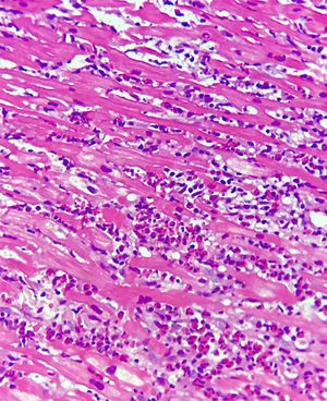 Corte histopatológico con H&E. Tejido de arquitectura irregular con presencia de severo infiltrado dado por eosinófilos y linfocitos maduros.