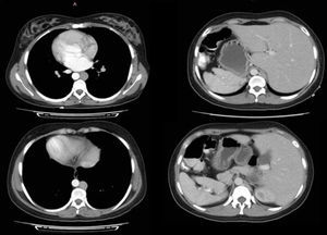 Situs inversus caso 1. Se evidencia trasposicion del ápex cardiaco (superior izquierda), grandes vasos (inferior izquierda), hígado y bazo (superior e inferior derecha).