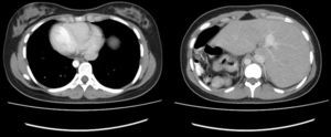 Trasposición de grandes vasos y ápex cardíaco (izquierda). Transposición de hígado y vesícula biliar (derecha).