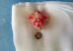 Hallazgo quirúrgico; tumor de aspecto mixomatoso de 2cm x 3cm y coil de 1,5cm de diámetro.