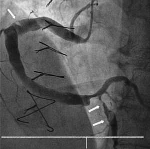 Primera coronariografía. Arteria coronaria derecha severamente dilatada. Apréciense defectos de perfusión (flechas) a varios niveles.