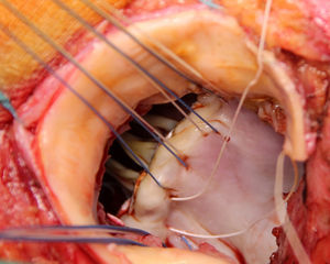 Implante de puntos mitrales realizado a través de la aortotomía ampliada.