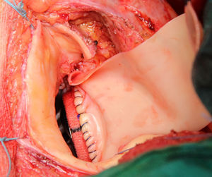 Prótesis mitral implantada en sus dos tercios posteriores. Sutura del parche de pericardio bovino a la prótesis mitral.