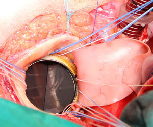 Implante de la prótesis aórtica en posición supraanular.